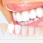 Veneers: Merging Aesthetic Precision with Oral Health Insights